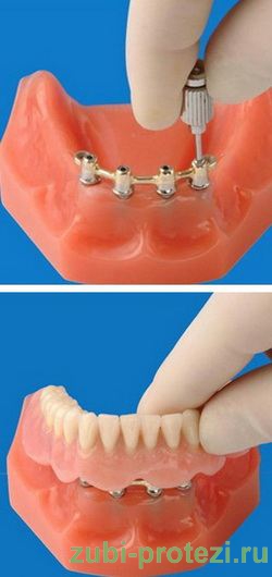 этапы протезирования зубов с балочным креплением