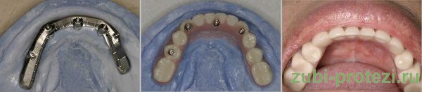 балочное протезирование зубов на имплантах
