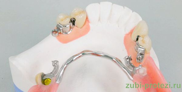 зубной протез на микрозамках фото