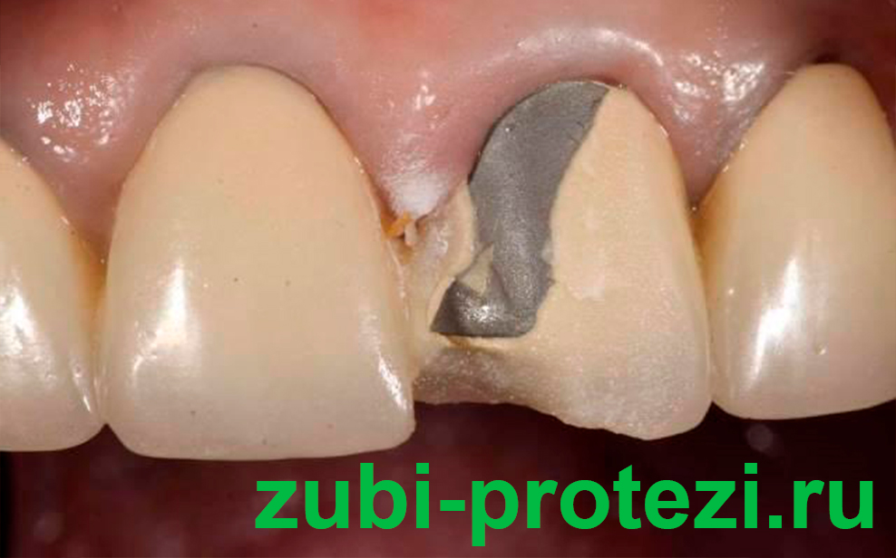 Как закрепить съемные зубные протезы