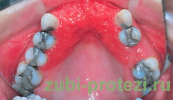Протезирование зубов при аллергии - миф или реальность?