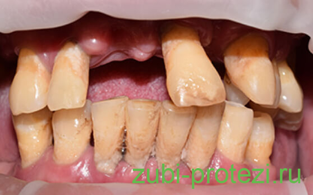 Протезирование верхней челюсти при отсутствии зубов