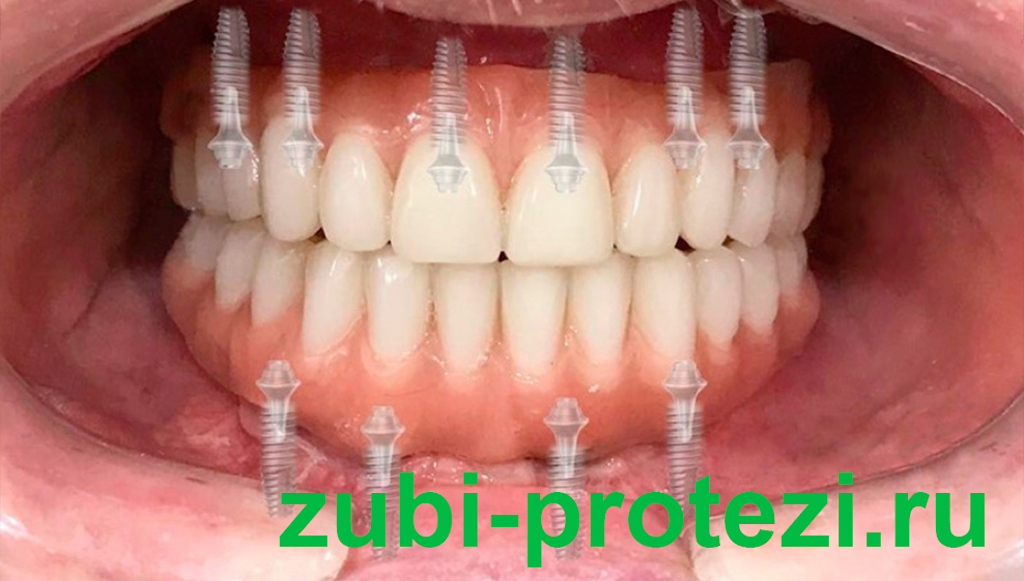 Нейлоновые зубные протезы: особенности изделий