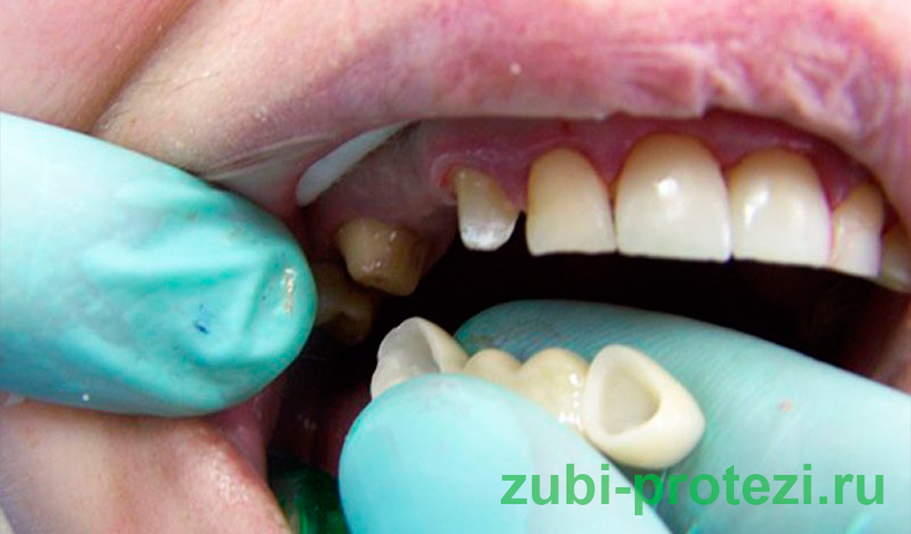Вопросы по протезированию зубов