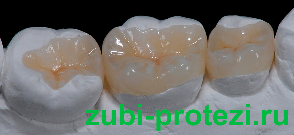 Как крепятся протезы, если нет крайних жевательных зубов