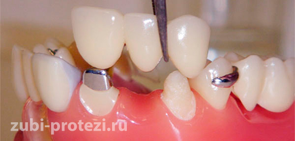 Протезирование после удаления зубов